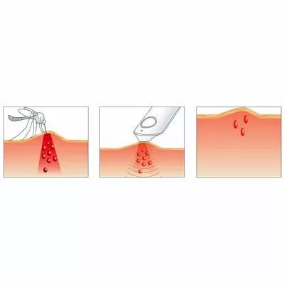 Healing heat accelerates healing and gives comfort
