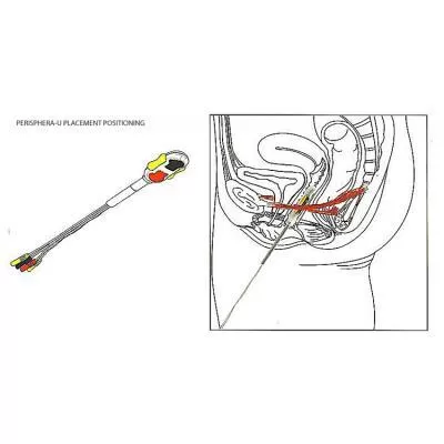 Image of Perisphera U positioning